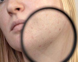 haarentfernung hannover,beauty,akne,behandlung,krampfadern,besenreiser,cellulite,couperose,dehnungsstreifen,pigmentflecken,poren,verjuengung,falten,haut,haare